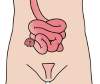 迴腸造口