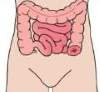 Colostomy